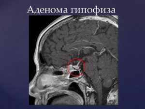 Гипофиз с выбухающим верхним контуром, микроаденома