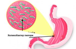 Хеликобактер пилори у ребенка 6 лет