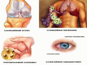 Хламидиоз, пожалуйста помогите