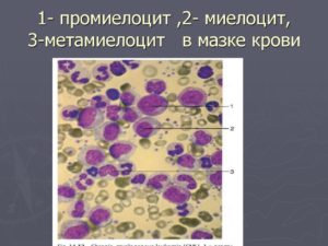 Нормобласты, метоциты и метамиелоциты в крови