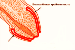 Опухла крайняя плоть головки