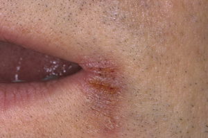 Папиллома на половой губе и коричневое пятно на слизистой