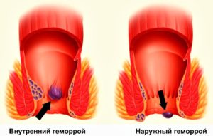 Образовалась шишка с черной точкой, наружный геморой