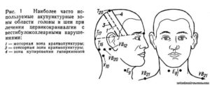 Немеет левая сторона