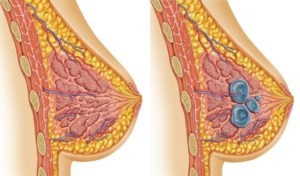 Фиброзно-кистозная мастопатия. Киста левой молочной железы. Эффективное лечение?