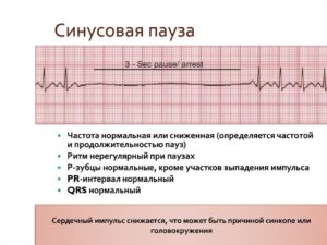 Пауза за счет синусовой аритмии