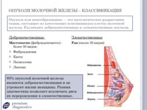 Новообразование в груди / мастопатия