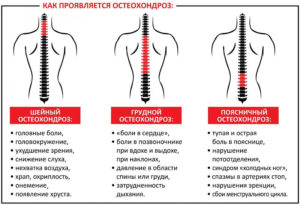 Остеохондроз, лечение