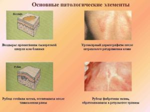 Папулы на слизистой рта как зппп