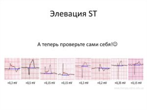 Неспецифиеские нарушения st-t (элевация)