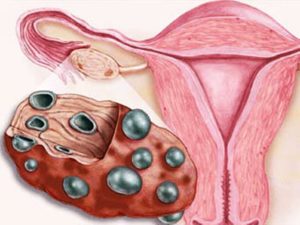 Гипоплазия матки, поликистоз яичников
