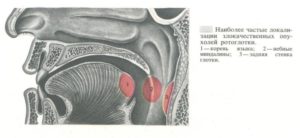 Образование на задней стенке глотки