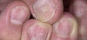 Грибковое поражение ногтевых пластин, кожи, себорея, псориаз