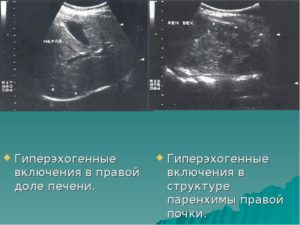 Гиперэхогенные включения в почках