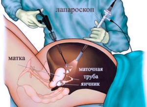 Нужна ли лапароскопия при дисфункции яичников