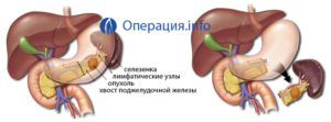 Образование в теле-хвосте поджелудочной