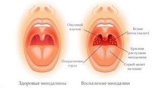 Опухла левая миндалина