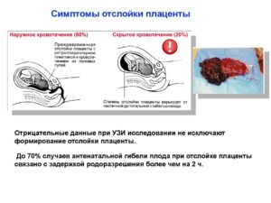 Отслойка плаценты смерть ребенка в 38 недель