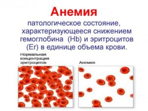 Обильные месячные-анемия