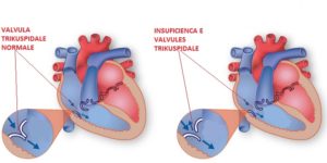 Незначительная регургитация на трикуспидальном клапане и клапане легочной артерии (1 степени