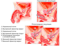 Отсутствие эякуляции