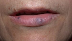 Гемангиома большой половой губы