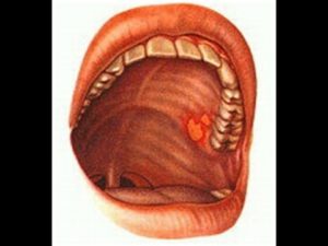 Гематома в полости рта