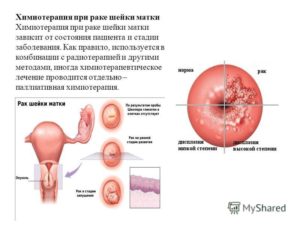 Химиотерапия после удаления матки