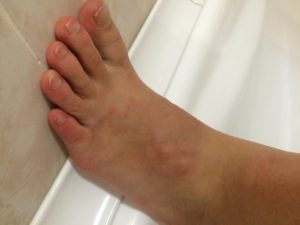 Фиолетовое пятно на ноге