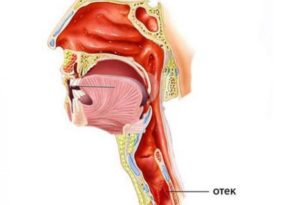 Отёк носоглотки у ребенка