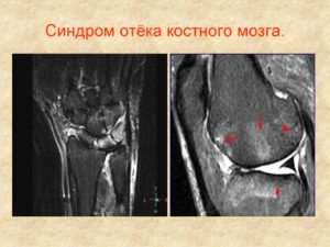 Отек костного мозга в теле левой подвздошной кости