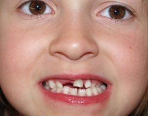 Пеньки передних зубов