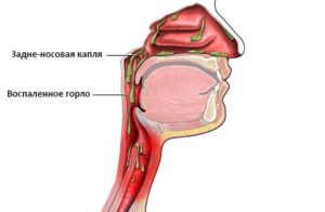 Ощущение слизистого комка в носоглотке