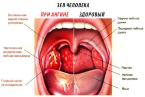 Ощущение слизистого комка в носоглотке