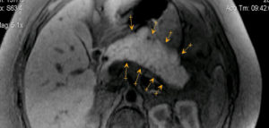 Панкреатит, расшифровка МРТ