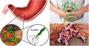 Хеликобактер пилори у ребенка 6 лет