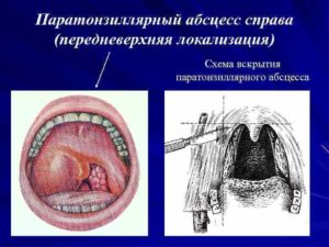 Паратонзиллярный абсцесс