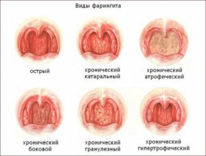 Ослабление иммунной системы, хронический тонзиллит, сыпь на теле