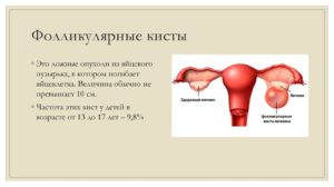 Фолликулярная киста 10см при беременности