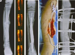 Открытая рана после операции на кость