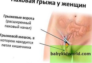 Образование в паховой складке во время беременности