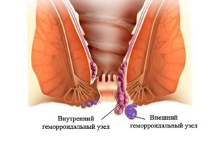 Геморроидальный узел на 26 неделе беременности