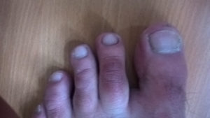 Фиолетовые пятна на подушечках пальцев ног
