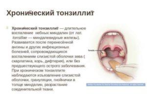 Гной на миндалине во время беременности