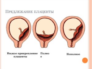 Низкое предлежание плаценты