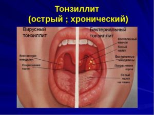 Острый тонзиллит