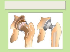 Осложнения после операции эндопротезирования тазобедренного сустава