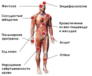 Гепатит С у меня и у мужа