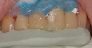 Отвалился кусок металлокпрамического зуба