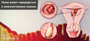 Норколут, гиперплазия эндометрия, полип эндометрия